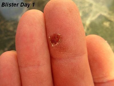 Finger Blister -Day 1