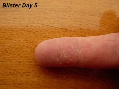 Finger Blister -Day 5