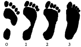 Flat feet