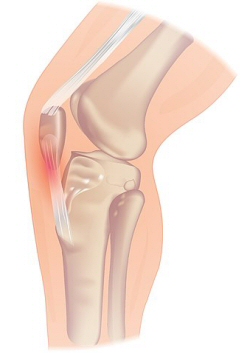 Jumpers Knee by InjuryMap on Wiki