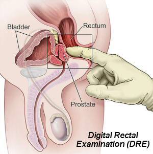 The Digital Rectal Examination - from Wikipedia